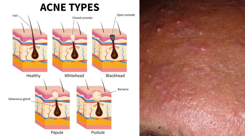 Clarifying the Complexity of Acne: A Comprehensive Medical and Lifestyle Guide to Clearer Skin